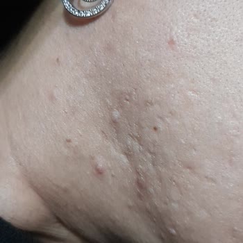 Duru Şampuan Memnuniyetsizliği