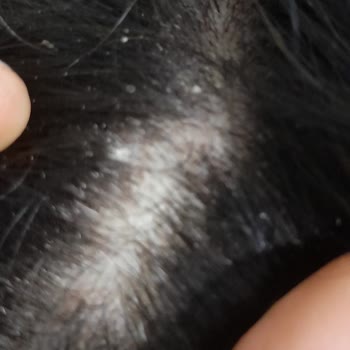 Duru Şampuan Memnuniyetsizliği