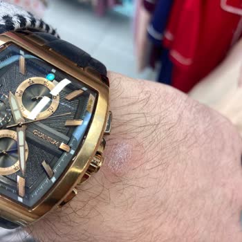 Quantum Saat Kasası Cilt Sağlığını Tehdit Ediyor