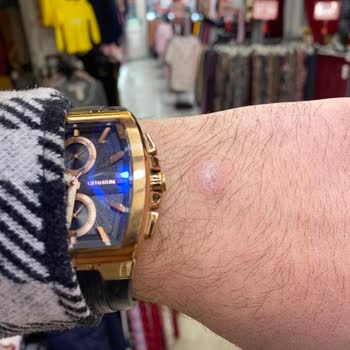 Quantum Saat Kasası Cilt Sağlığını Tehdit Ediyor