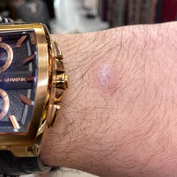 Quantum Saat Kasası Cilt Sağlığını Tehdit Ediyor