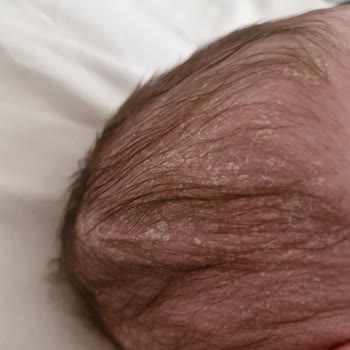 Mustela Şampuanı Bebeğimin Cildini Mahvetti