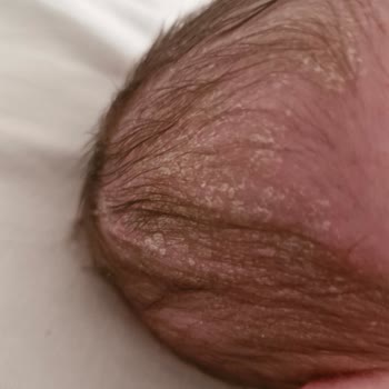 Mustela Şampuanı Bebeğimin Cildini Mahvetti