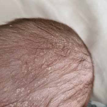 Mustela Şampuanı Bebeğimin Cildini Mahvetti