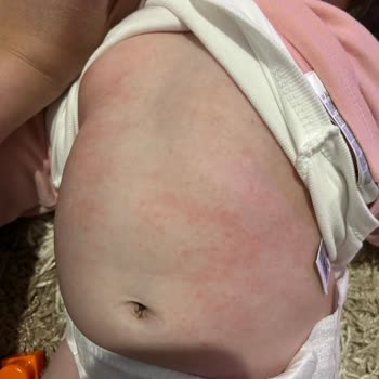 Bebek Cildinde Mustela Stelatopia'nın Beklenmedik Etkisi