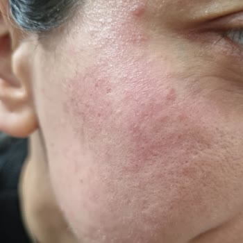 Nivea Toniği Yüzümde Ciddi Sorunlara Neden Oldu