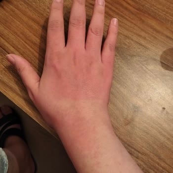 Body Peeling Ürünü Ciltte Alerjik Reaksiyona Sebep Oldu