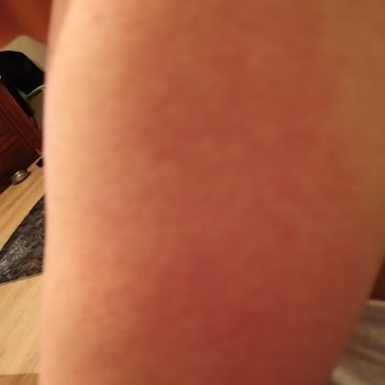 Body Peeling Ürünü Ciltte Alerjik Reaksiyona Sebep Oldu