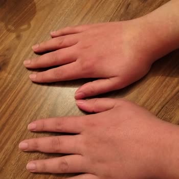 Body Peeling Ürünü Ciltte Alerjik Reaksiyona Sebep Oldu