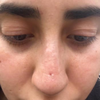 Cansu Erdem Beauty Center Sağlıkla Oynayan Dolgu Deneyimi