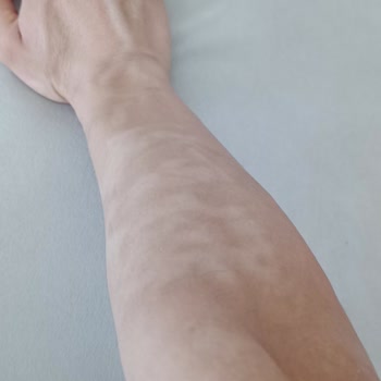 Lazer Epilasyon Sonrası Yanık Ve Hijyen Sorunları