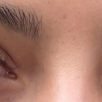 Göz Yanması Ve Kalitesiz Hizmet Deneyimi