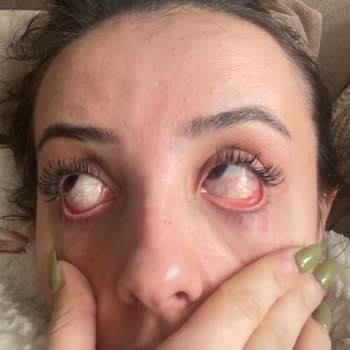 Hijyen Eksikliği Ve İlgisizlik Nedeniyle Kirpik Sorunu