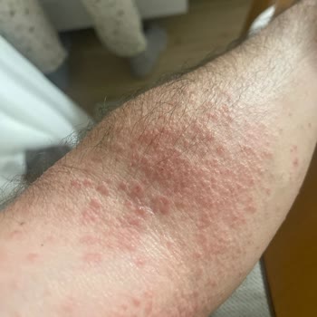 Veet Krem Sonrası Cilt Sorunları