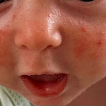 Mustela Ürünleri Yenidoğan Cildinde Alerjiye Sebep Oldu