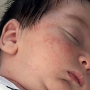 Mustela Ürünleri Yenidoğan Cildinde Alerjiye Sebep Oldu