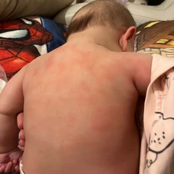 Ecowell Bebek Losyonu Cilt Alerjisine Sebep Oldu!