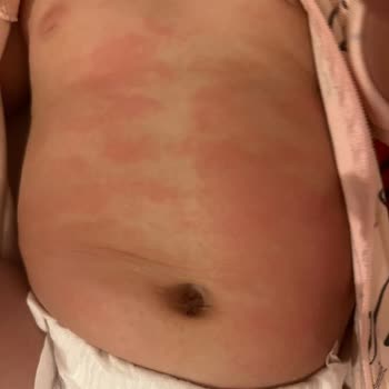 Ecowell Bebek Losyonu Cilt Alerjisine Sebep Oldu!