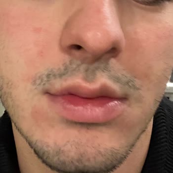 Cerave Limpiador Facial provoca irritaciones en la piel