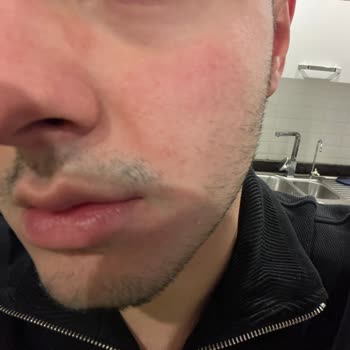 Cerave Limpiador Facial provoca irritaciones en la piel