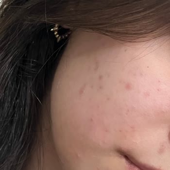 Loreal Paris True Match Foundation Caused Severe Acne and Redness