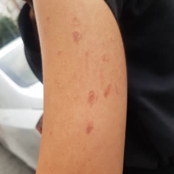 Golden Light Güzellik Merkezi Lazer Seansında Cilt Yanıkları Ve Uzun Süreli İyileşme Sorunu