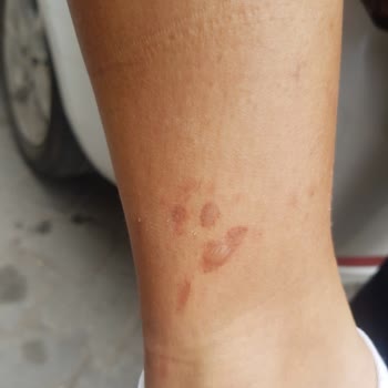 Golden Light Güzellik Merkezi Lazer Seansında Cilt Yanıkları Ve Uzun Süreli İyileşme Sorunu