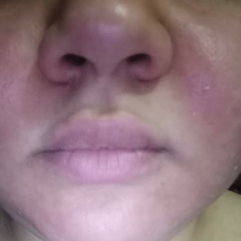 Neutrogena Revitalizing Peeling Gel Caused Burning and Acne