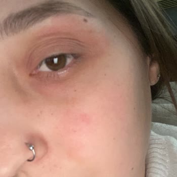 Kiko Nemlendirici Alerjisi: Nişan Öncesi Cilt Sorunu