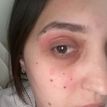 Kiko Nemlendirici Alerjisi: Nişan Öncesi Cilt Sorunu