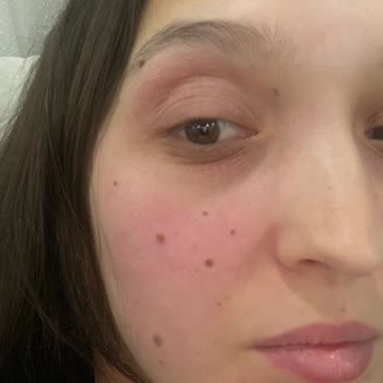 Kiko Nemlendirici Alerjisi: Nişan Öncesi Cilt Sorunu