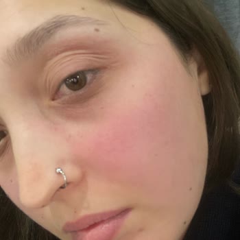 Kiko Nemlendirici Alerjisi: Nişan Öncesi Cilt Sorunu