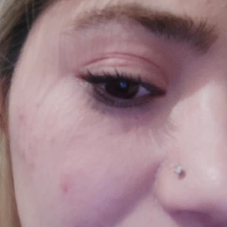 Kirpik Lifting Sonrası Hijyen Sorunu Ve Yanıltıcı Bilgilendirme