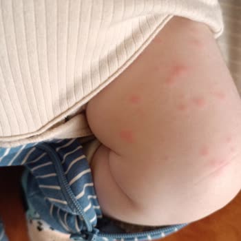 Mustela Krem Kullanımı Sonrası Beklenmedik Cilt Reaksiyonu