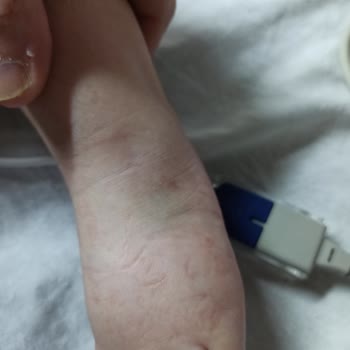 Bebeğime Yapılan Yanlış Tedavi Ve Hemşire Eksikliği