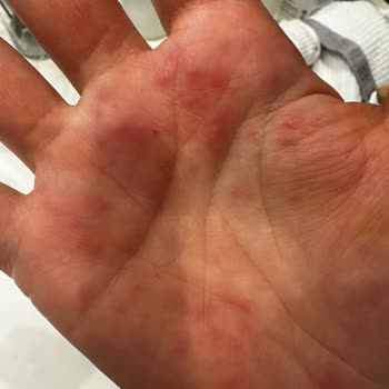Olivos El Sabunu Ciltte Yanma Ve Kabarcıklara Neden Oluyor