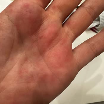 Olivos El Sabunu Ciltte Yanma Ve Kabarcıklara Neden Oluyor