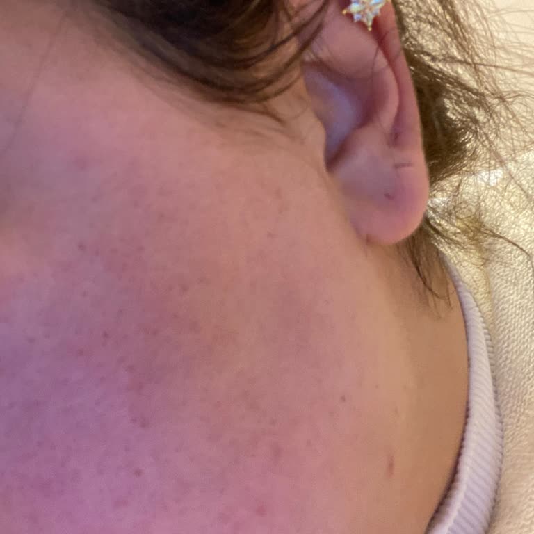 I Got Burning and Dark Spots from Clinique Moisture Lotion After Just 2 Days of Use