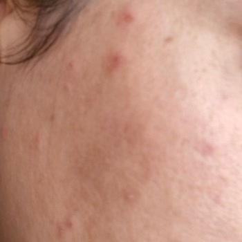 Bee Beauty Yüz Maskesi Sonrası Cilt Sorunları