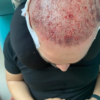 Saç Ekimi Sonrası Memnuniyetsizlik