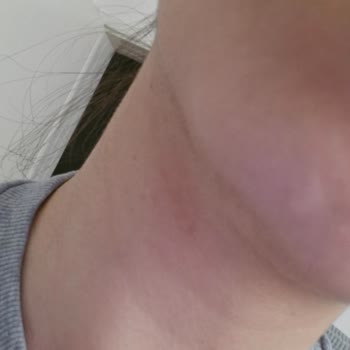 Cream Co. Cilt Sorunlarına Neden Olan Güneş Kremi Deneyimi