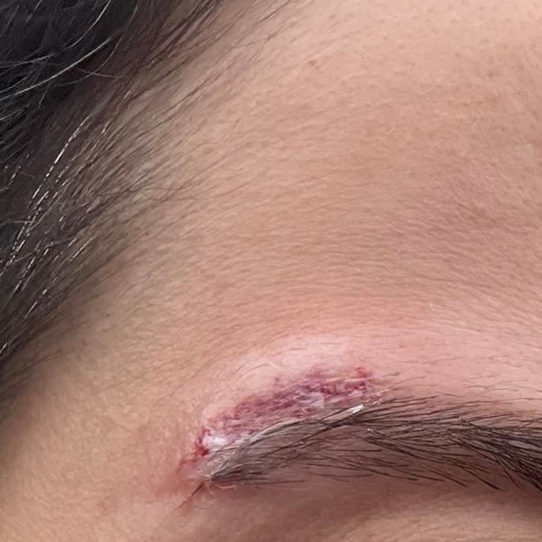 Linessa Beauty Lounge Kaş Sildirme İşleminde Beklenmeyen Sonuçlar Ve Yan Etkiler