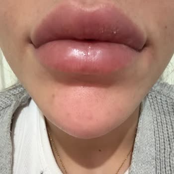 Estetik İşlemde Hayal Kırıklığı Ve İlgisizlik