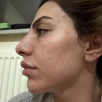 Estetik İşlemde Hayal Kırıklığı Ve İlgisizlik