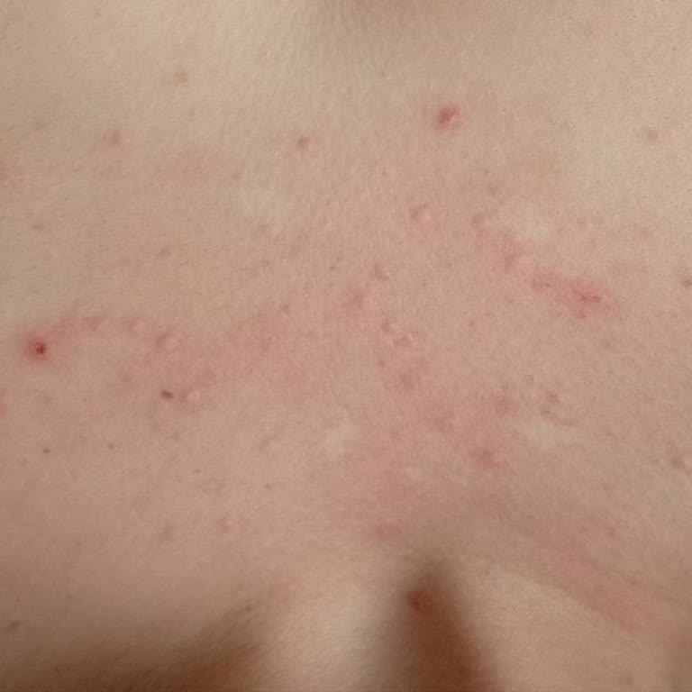 Alerji Yapan Yumuşatıcı