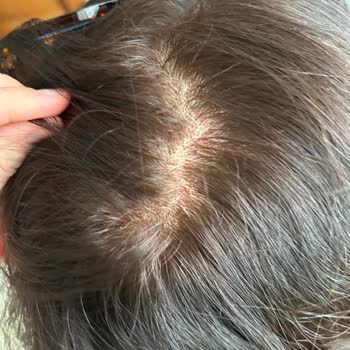 Saç Boyası Kullanımında Cilt Yanması