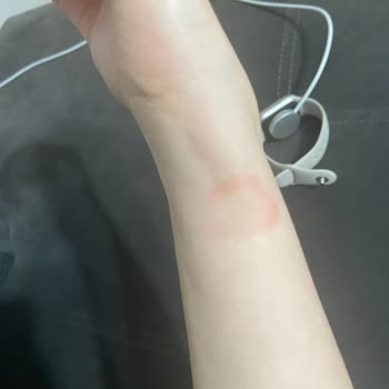 Apple Watch 8 Kordonu Ciltte Yanık Oluşturuyor