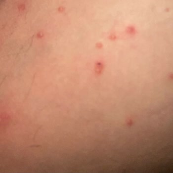 Day2day Kolajen Kullanımında Cilt Problemleri