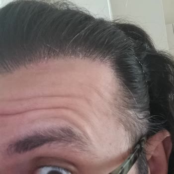 Kepeğe Karşı Etkili Şampuan Saçlarımı Mahvetti