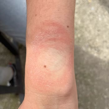 Huawei Akıllı Saat Egzama Sorunu Çözülmüyor